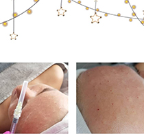 Biorevitalizācija